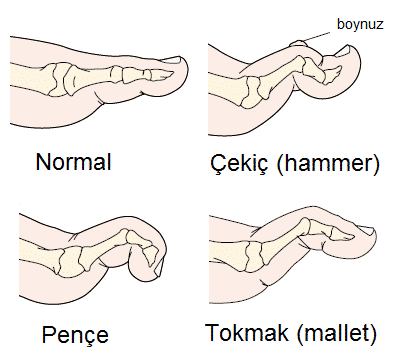 Çekiç Parmak ve Pençe Parmak