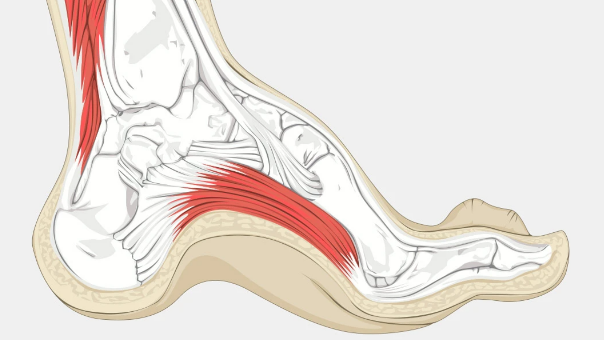 Aşırı Kavisli Ayak (Pes Cavus)